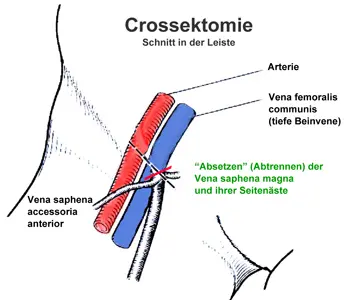 Crossektomie